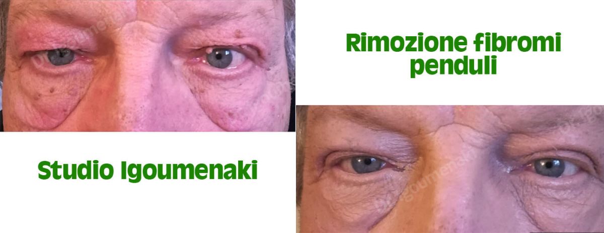 Rimozione Fibromi penduli